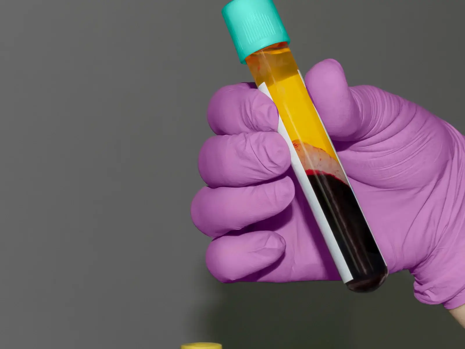 Blood samples being prepared for hormone and metabolic lab work as part of an erectile dysfunction workup in South Tempe, AZ