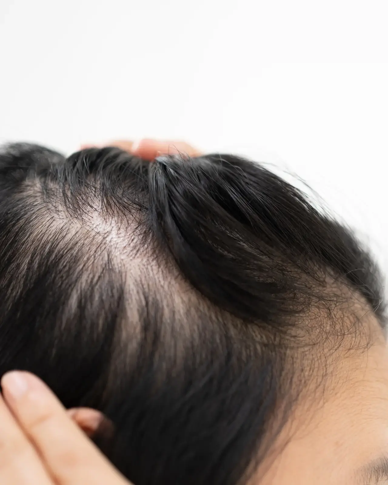 Close view of a thinning part line, a common early sign of hair loss, in South Tempe, AZ