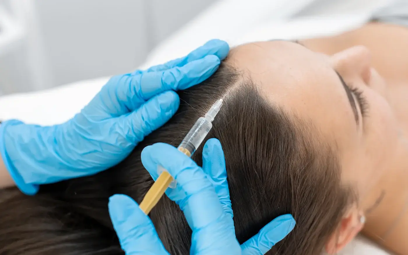 PRP scalp treatment for thinning hair at a South Tempe, AZ clinic