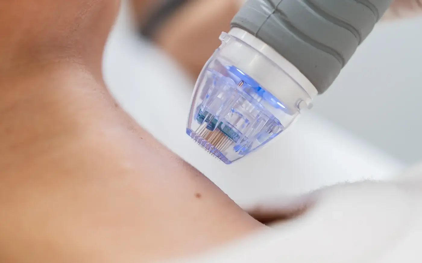 RF microneedling handpiece used for skin tightening in South Tempe, AZ