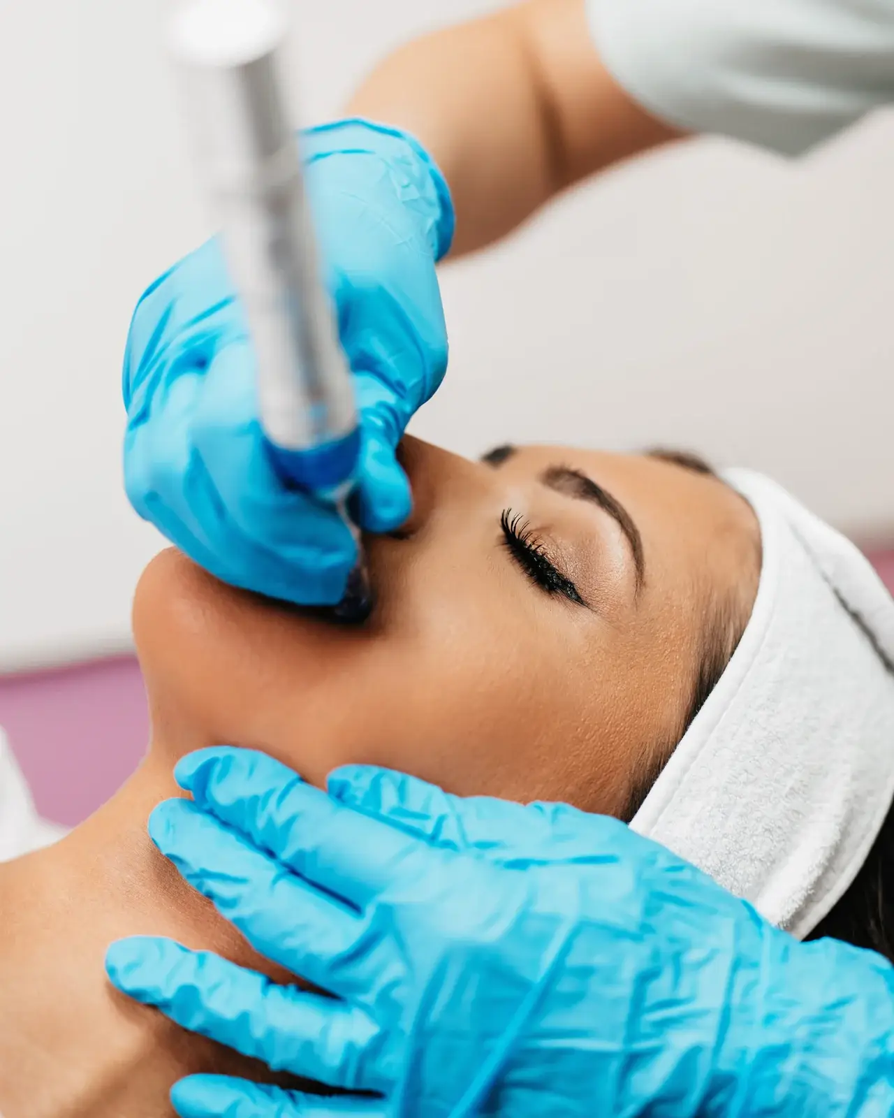 A gloved clinician performing a microneedling treatment along a patient cheek in South Tempe, AZ