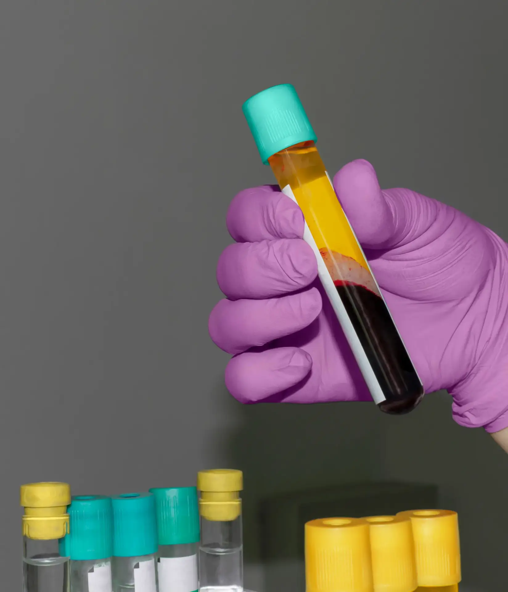 Platelet-rich plasma separated from a patient's own blood sample at a South Tempe, AZ clinic